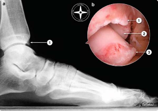 Imagen lateral de rayos x y artroscopica (b) que muestra osteofitos de tobillo 1, 2 y 3