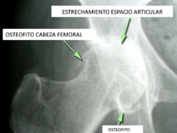 Radiografia Osteofito y daño articular de cadera