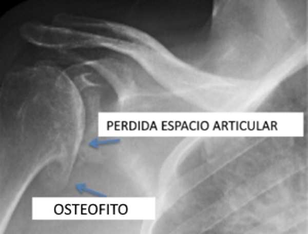 Radiografia Osteofito y daño articular en hombro