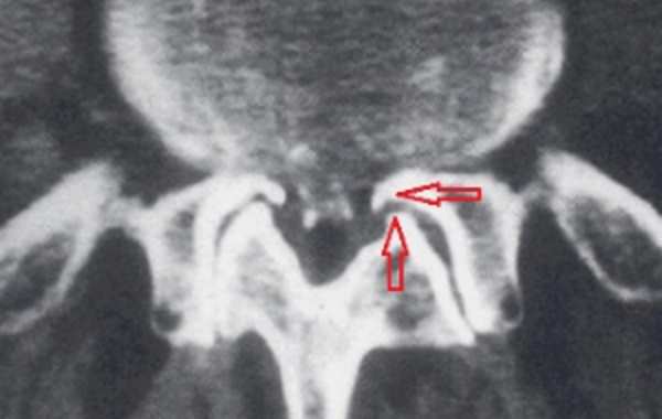 Tomografia computarizada de osteofitos en columna vertebral