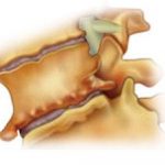 Osteofito cervical