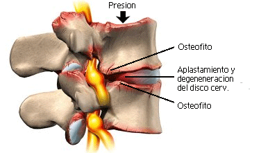 osteofitos cervicales por aplastamiento y degeneracion del disco cervical 2