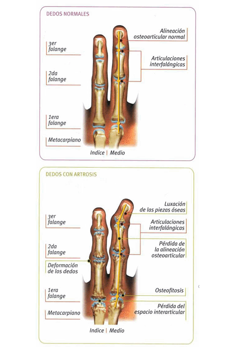 Artrosis de mano, mano normal y mano con artrosis