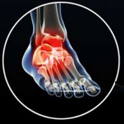 Artrosis de pie
