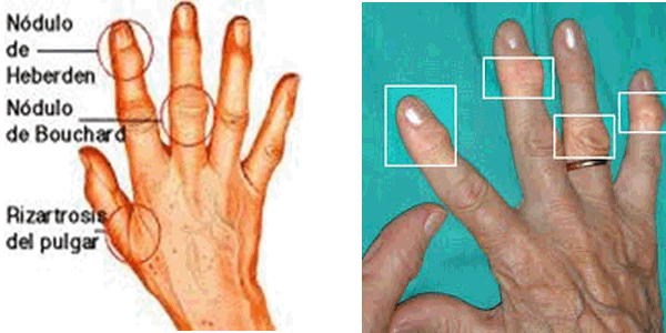 Sintomas generales de la artrosis en las manos
