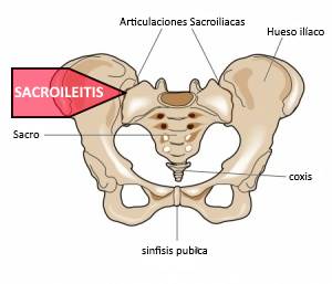 Anatomia de la sacroileitis