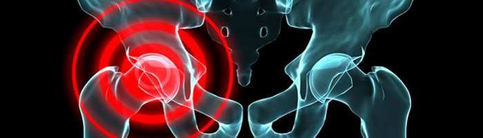 Ocupacion y riesgo de artrosis