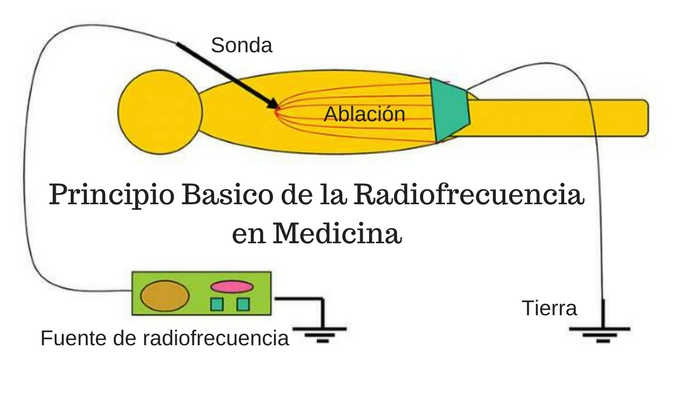 ablación del nervio genicular por radiofrecuencia enfriada para dolor por artrosis de rodilla