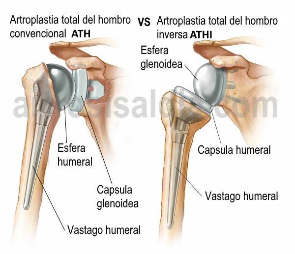 Artroplastia total del hombro vs Artroplastia total inversa del hombro 1