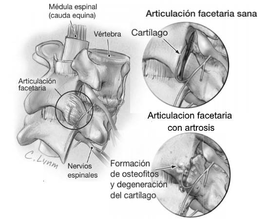 Artrosis de columna degeneración del cartílago de la articulación facetaria y formación de osteofitos