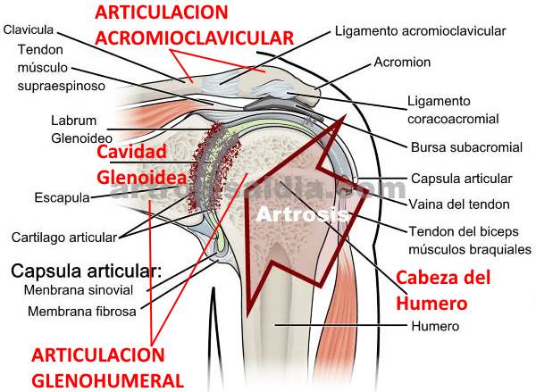 Descripción gráfica de la artrosis de hombro