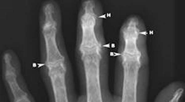 Radiografia de osteofitos en los dedos