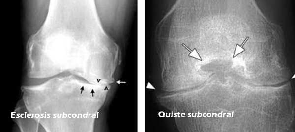 Esclerosis subcondral: síntomas causas tratamiento